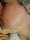 After Acne Clearance Treatment