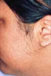 After Hair Remove