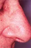 After Deep Veins Treatment