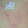 After Deep Veins Treatment