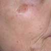 Before Pigmented Lesions Treatment