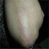 After Psoriasis & Leukoderma Treatment