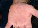 After Psoriasis & Leukoderma Treatment