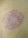 After Tattoo Removal Treatment