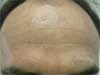 After Tattoo Removal Treatment