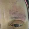 After Vascular Lesions Treatment