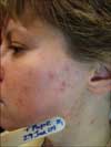 Before Acne Clearance Treatment