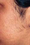 Before Hair Remove