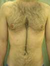 Before Hair Remove