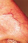 Before Deep Veins Treatment