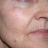 After Pigmented Lesions Treatment