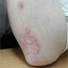Before Psoriasis & Leukoderma Treatment