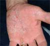 Before Psoriasis & Leukoderma Treatment