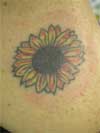 Before Tattoo Removal Treatment