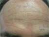 Before Tattoo Removal Treatment