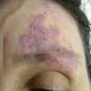 Before Vascular Lesions Treatment